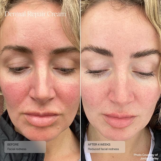 Senté Dermal Repair Facial Cream | Nourishing for Rosacea & Sensitive Skin | Hydrate & Rejuvenate | with Patented HSA, Vitamin E & Green Tea Extract - 1.7 Fl Oz