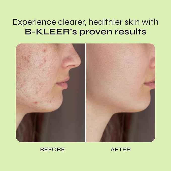 A-Cute Derm B-Kleer Cleansing Gel Acne Cleanser that Purify and Protect Your Skin from Clogged Pores for All Skin Types (8oz)
