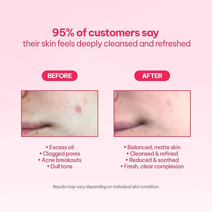 AC Clarifying Foam Cleanser 150ml/5.1 fl.Oz, Daily Facial Cleanser for Oily Skin, Unscented, Salicylic Cleanser, BHA, Korean Skincare