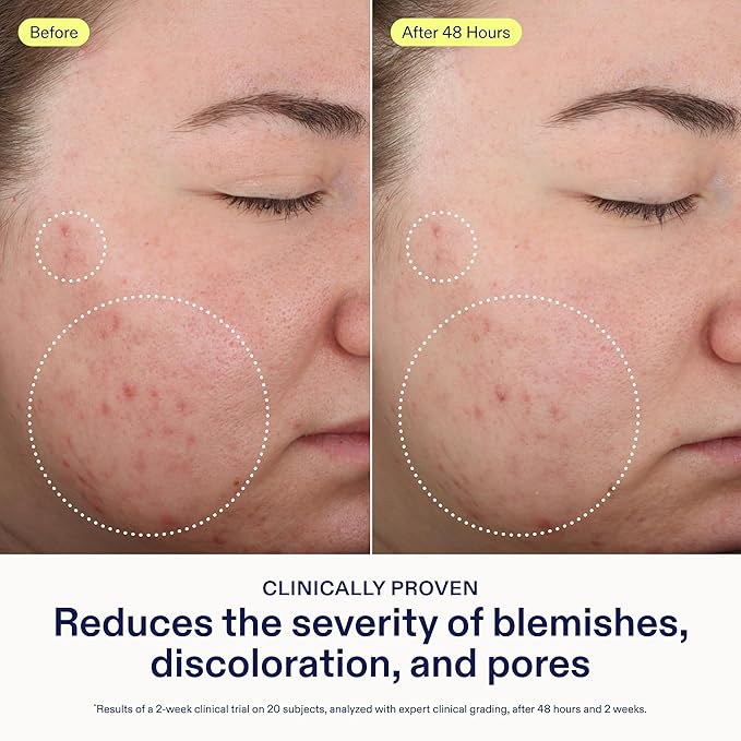 Skinfix 2% BHA Cleanser - 5 oz - Clears Acne Blemishes & Blackheads - Safe for All Types of Acne - Fragrance Free - Vegan, Cruelty Free